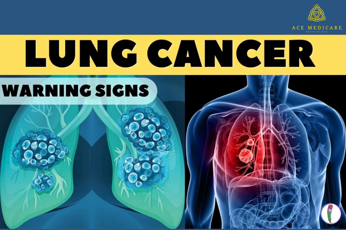 The Silent Killer: Understanding Lung Cancer and Its Impact